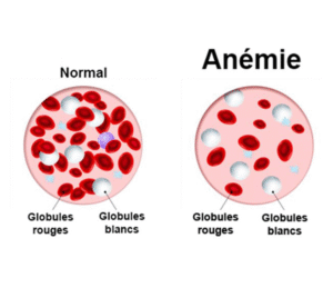 Bienvenue sur Info-Anémie